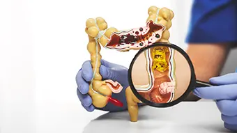 La ventana de los diez años: el avance científico que permite neutralizar el cáncer colorrectal antes de su aparición